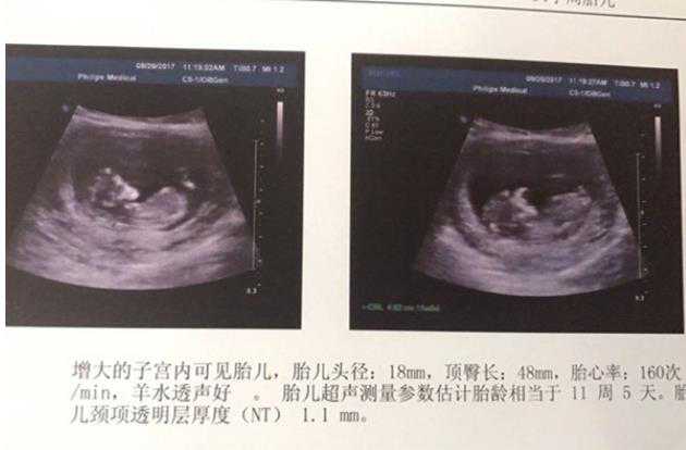 深圳医院供卵试管 深圳三代试管婴儿的姐妹经验分享 ‘怀男宝宝妈妈特征’